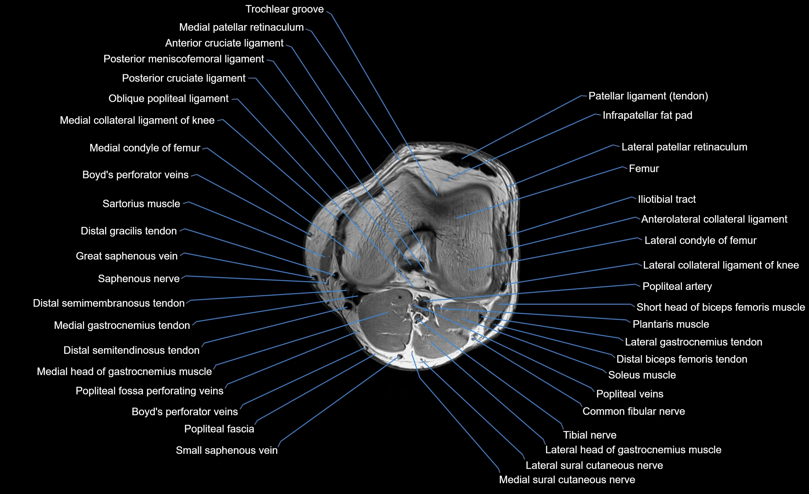 MRI lower leg axial cross sectional anatomy 3T  radiology  image-img-00001-00014.webp